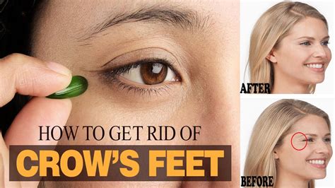 best way to remove crows feet