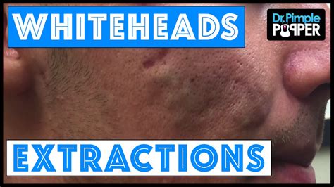 Best Whitehead Extractions
