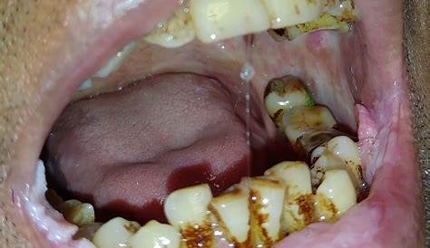 Betel Nut And Oral Cancer Maycintadamayantixibb Chewing
