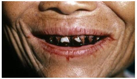 From Betel Nut Stained Teeth Of A Thai Woman Stock Photo