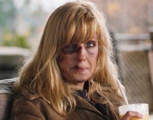 beth dutton bruised face