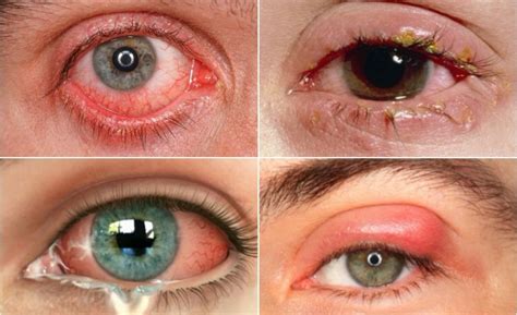 biến chứng đau mắt đỏ