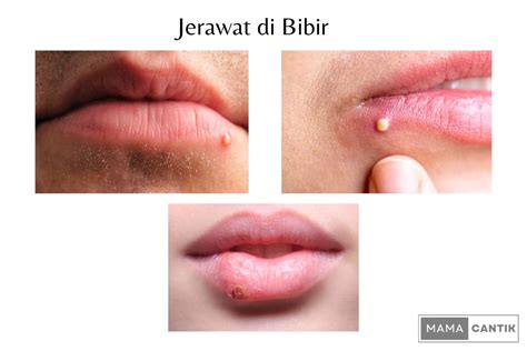 bibir berjerawat