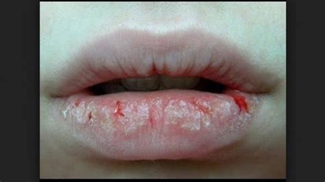 bibir bengkak akibat infeksi