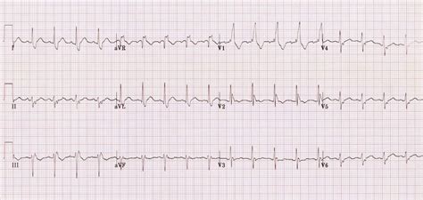 Bifascicular Block Ecg Images