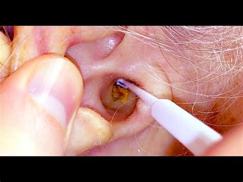 198 Ear Wax Ball HOOKED and PINCHED out of Ear Mr Neel Raithatha
