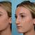 big nose rhinoplasty before and after