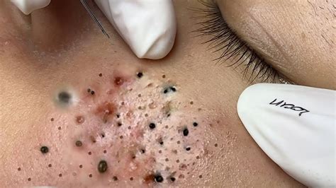 big blackhead extractions