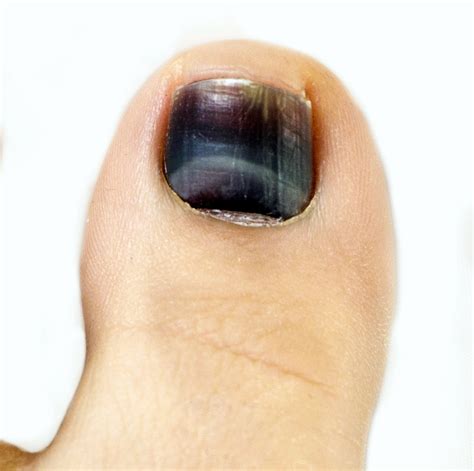 big toe nail turning blackish