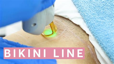 bikini area laser hair removal