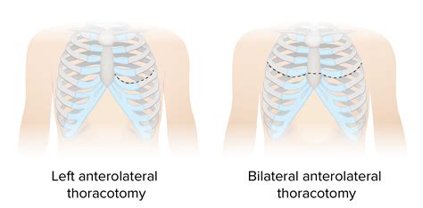 Bilateral Clamshell Thoracotomy