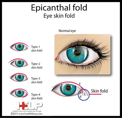 bilateral epicanthal folds