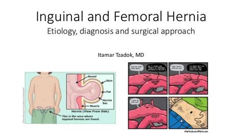 bilateral inguinal hernia repair icd 10