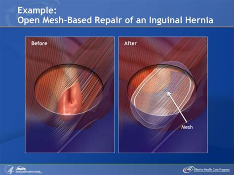 bilateral inguinal hernia repair with mesh