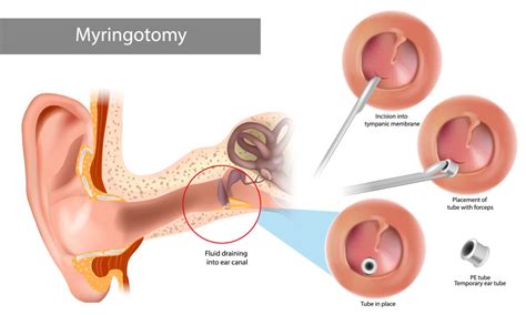 Bilateral Myringotomy With Grommet Insertion Cpt Code