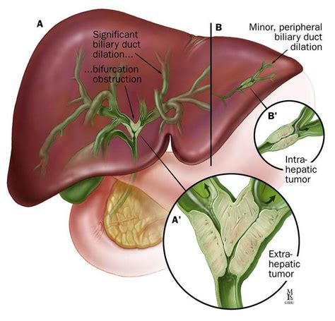 bile duct malignancy