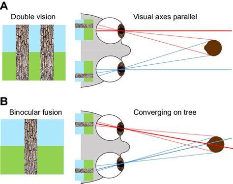 Binocular Double Vision Ddx