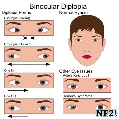 Binocular Eye Diplopia