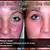 bio oil acne scars results