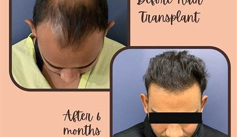 Biofibre Hair Implant Side Effects Sign In Transplant Surgery, Transplant In