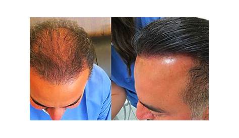 Biofibre Hair Implant Uk Rejuvenate Clinics 2017