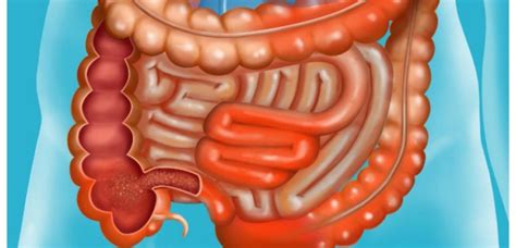 biologie maladie de crohn