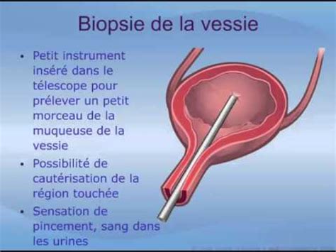 biopsie de la vessie chez la femme