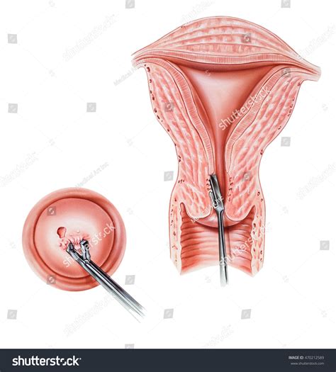 Understanding the Biopsy of Cervix: What to Expect and Why It's Done