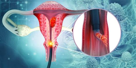 biopsy of the endometrium