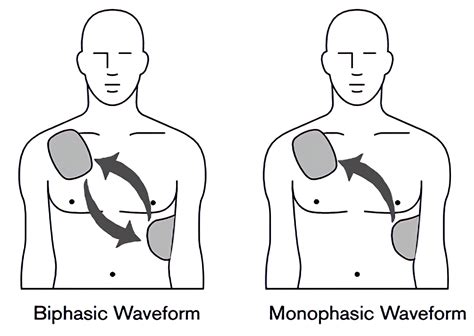 Biphasic And Monophasic Defibrillation Waveforms