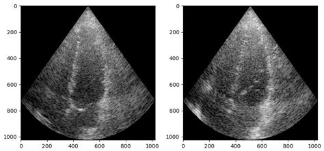 bistable ultrasound images
