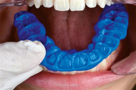 Bite Registration Orthodontics