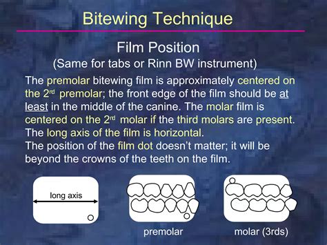 Bitewing Bisecting Technique