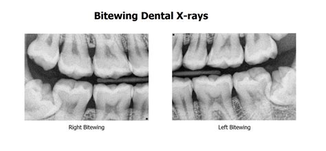 Secrets Unveiled by Bitewing X-Rays: What Dentists See