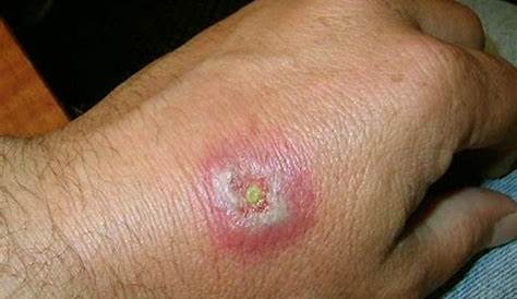 An example of a black widow spider bite showing an oval
