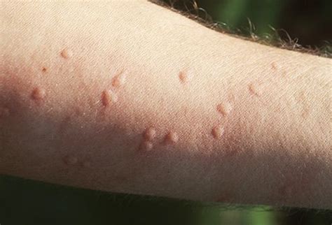 black ant bites allergic reaction