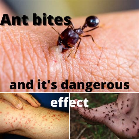 black ant bites allergic reaction