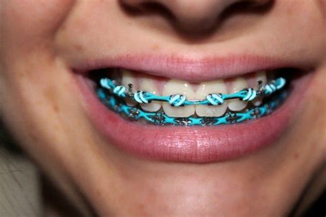Black Braces Designs