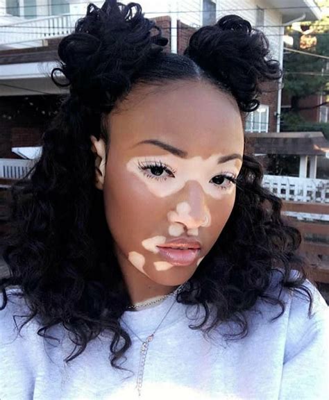 black girl with vitiligo