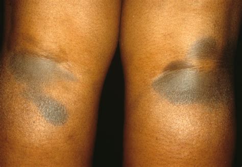 Black Patch Behind Knee