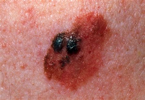 black skin cancer spots