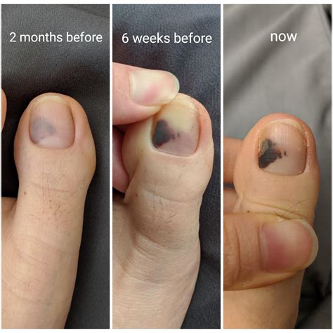 Black Spot Inside Toenail