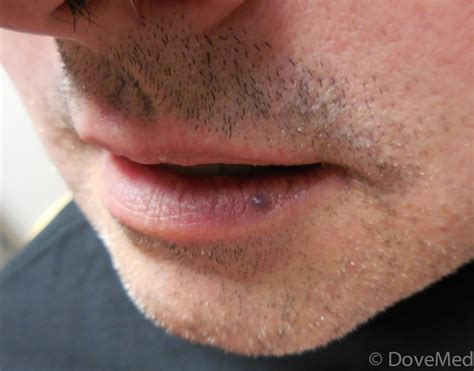 black spot on lip melanoma