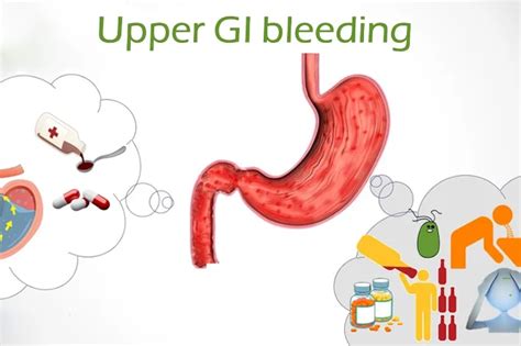 Black Stool Upper Gi Bleed