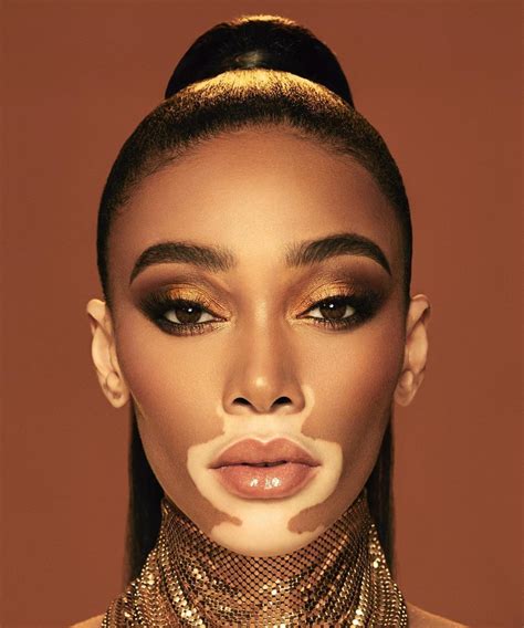 black supermodel with vitiligo