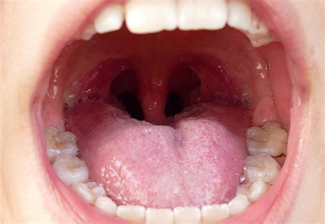 black tonsil stones pictures