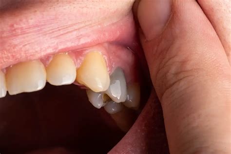 Black Tooth Under Temporary Crown