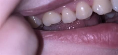 Black Triangles Between Teeth Reddit