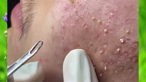 Blackhead And Pimple Extraction