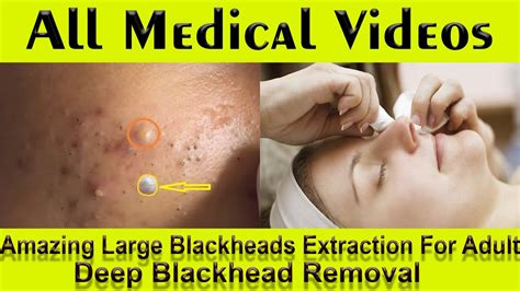 blackhead removal - youtube